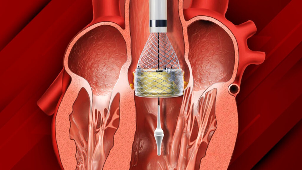 mitral-balon-valvuloplasti